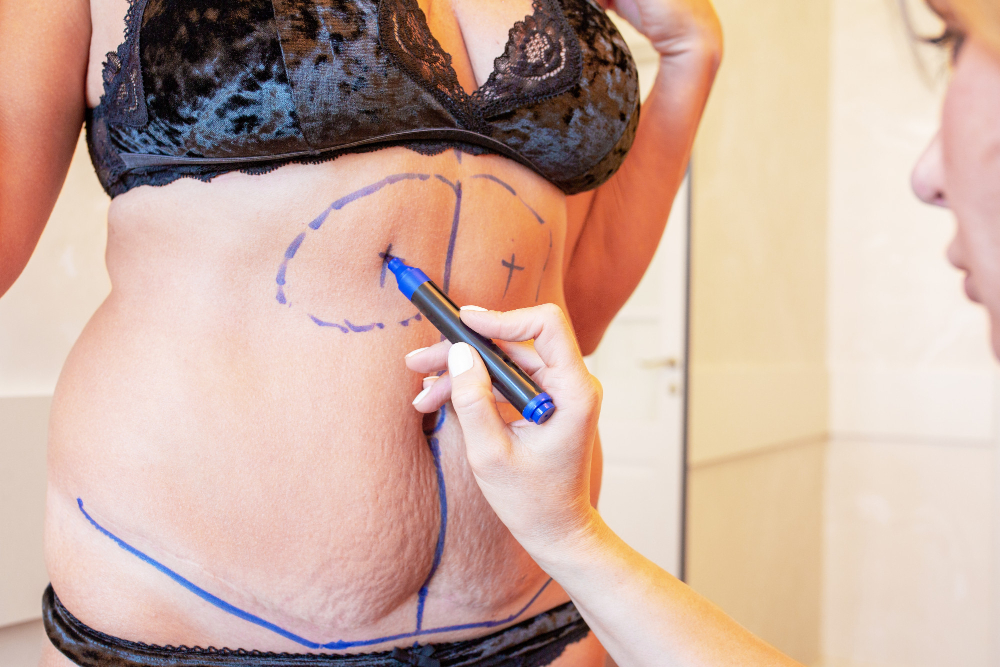 Nach Schwangerschaft immer noch Bauch: Eine Bauchdeckenstraffung Türkei